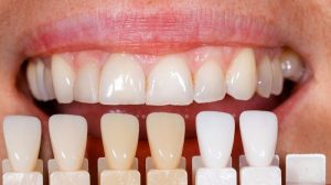 Different shades of teeth to match the colors of veneers