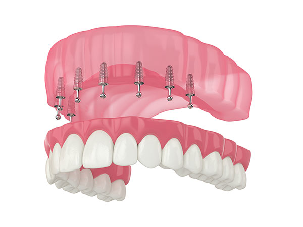 snap-in dentures