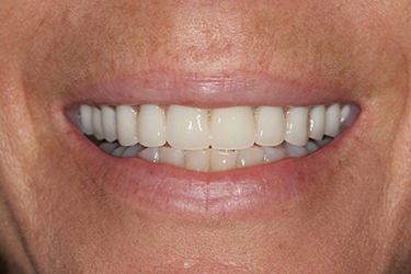 implant-supported-dentures-after-1