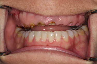 implant-supported-dentures-before-1